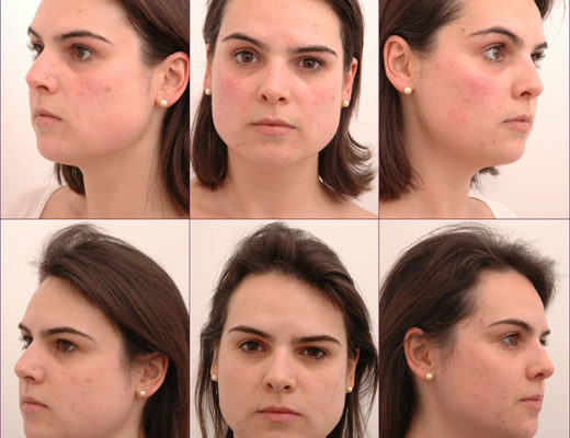 tratamento para rosácea