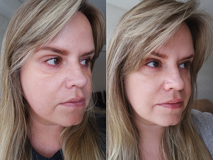 antes e depois do procedimento de lifting facial [2023]