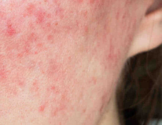 Capa Ácido Azelaico