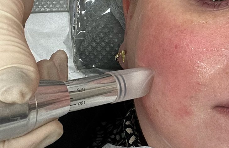 fiz microagulhamento com foco no melasma